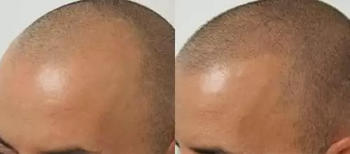 Micropigmentation et tricopigmentation du cuir chevelu